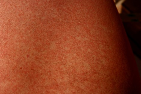 Wir haben die Pest an Bord: Thomas hat ein Allergisches Exanthem